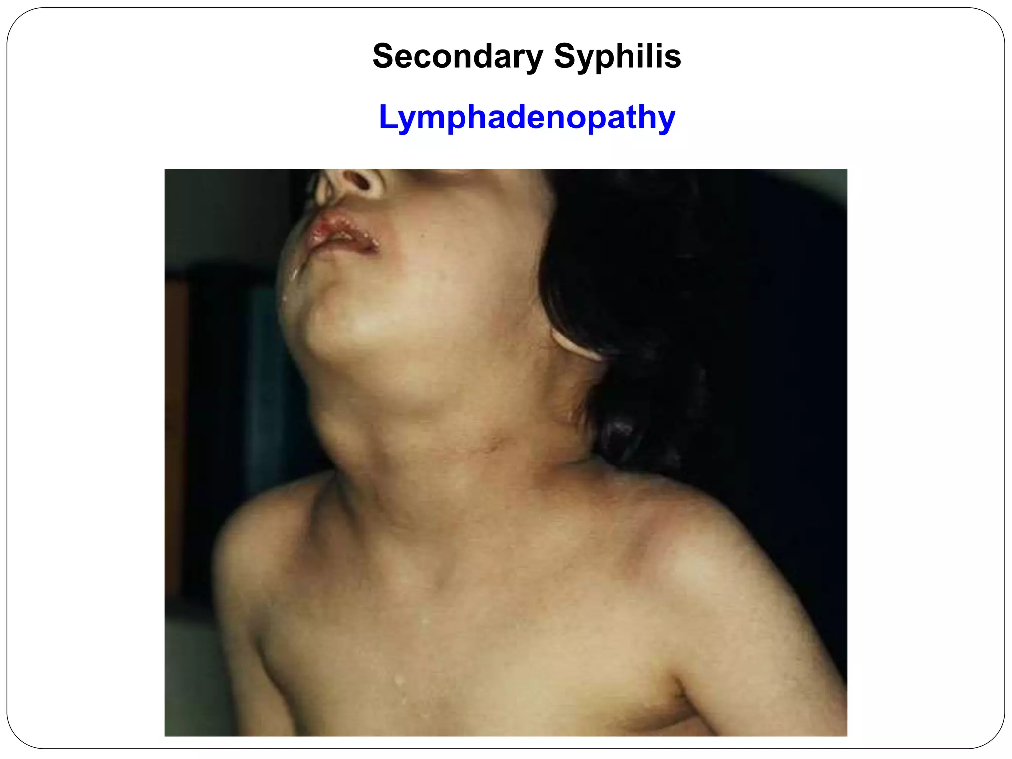 PHIRANGA (Syphillis) | PPSX