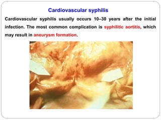 PHIRANGA (Syphillis) | PPSX