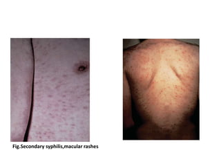 Syphilis Reticular Rash Maculopapular Rash Syphilis