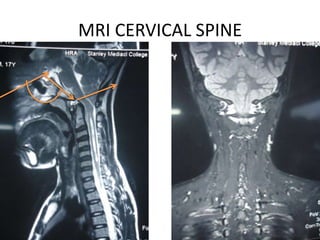 MRI CERVICAL SPINE