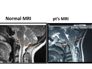 Normal MRI     pt’s MRI