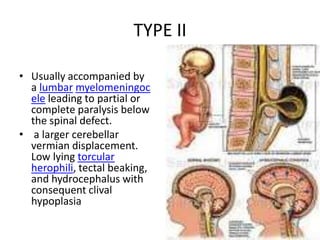 TYPE IIUsually accompanied by a lumbar myelomeningocele leading to partial or complete paralysis below the spinal defect.   a larger cerebellarvermian displacement. Low lying torcularherophili, tectalbeaking, and hydrocephalus with consequent clivalhypoplasia