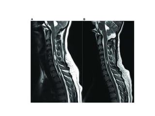 Syringomyelia Rash Syringomyelia | PPT
