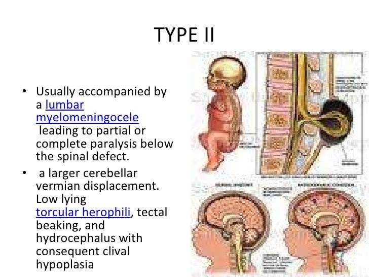 A Case of Syringomyelia with Arnold-Chiari Malformation