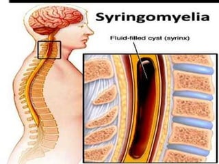 Syringomyelia Rash -syringomyelia clinical and pt neuro pp | PPTX