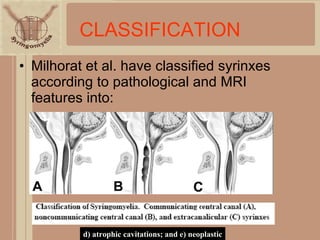 CLASSIFICATION Milhorat et al. have classified syrinxes according to pathological and MRI features into: d) atrophic cavitations; and e) neoplastic 