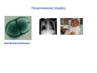 Πνευμονιοκοκκικές λοιμώξεις




Gram θετικός διπλόκκοκος
 