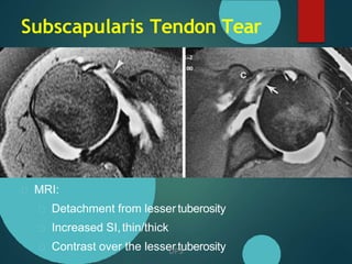 Systematic interpretation of shoulder MRI: DR. D. P. SWAMI | PPTX