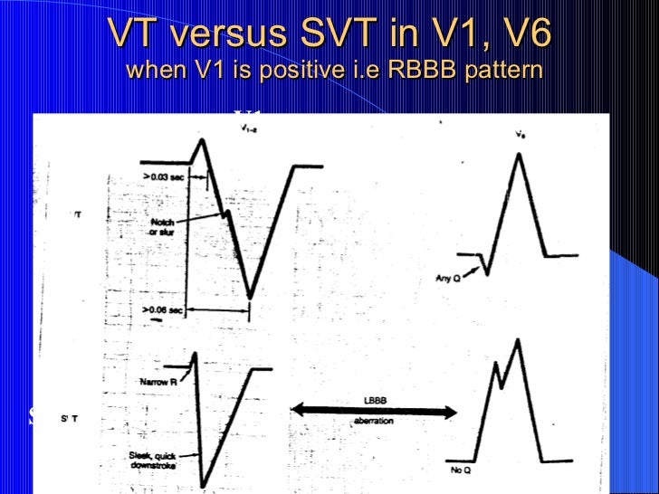 Systematic approach to wide qrs tachycardia