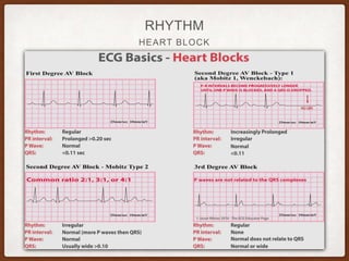 HEART BLOCK
RHYTHM
 