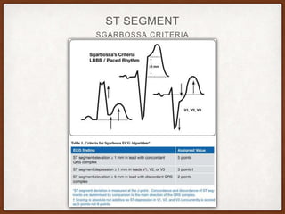 SGARBOSSA CRITERIA
ST SEGMENT
 