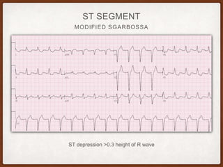 MODIFIED SGARBOSSA
ST SEGMENT
ST depression >0.3 height of R wave
 