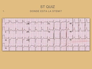 DONDE ESTA LA STEMI?
ST QUIZ
1.
 