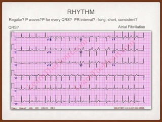 RHYTHM
Regular? P waves? PR interval? - long, short, consistent?P for every QRS?
QRS? Atrial Fibrillation
 