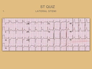 LATERAL STEMI
ST QUIZ
1.
 