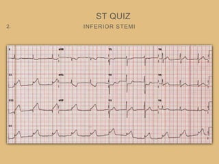 INFERIOR STEMI
ST QUIZ
2.
 