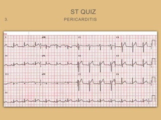 PERICARDITIS
ST QUIZ
3.
 