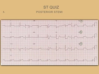 POSTERIOR STEMI
ST QUIZ
4.
 