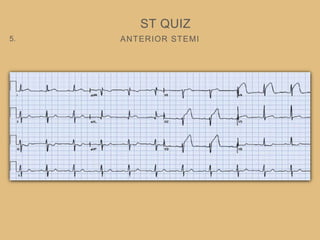 ANTERIOR STEMI
ST QUIZ
5.
 