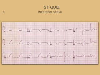 INFERIOR STEMI
ST QUIZ
6.
 