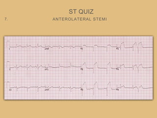 ANTEROLATERAL STEMI
ST QUIZ
7.
 