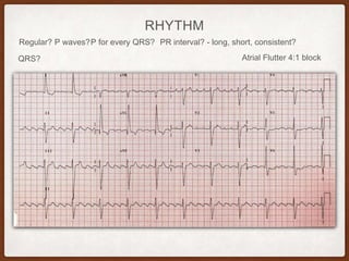 RHYTHM
Regular? P waves? PR interval? - long, short, consistent?P for every QRS?
QRS? Atrial Flutter 4:1 block
 