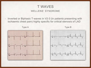 WELLENS’ SYNDROME
T WAVES
• Inverted or Biphasic T-waves in V2-3 (in patients presenting with
ischaemic chest pain) highly specific for critical stenosis of LAD
Type A Type B
 