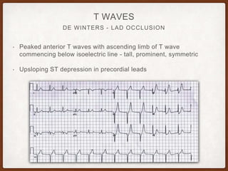 DE WINTERS - LAD OCCLUSION
T WAVES
• Peaked anterior T waves with ascending limb of T wave
commencing below isoelectric line - tall, prominent, symmetric
• Upsloping ST depression in precordial leads
 