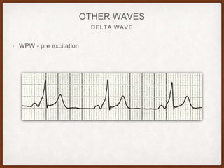 DELTA WAVE
OTHER WAVES
• WPW - pre excitation
 