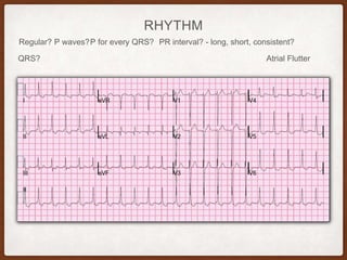 RHYTHM
Regular? P waves? PR interval? - long, short, consistent?P for every QRS?
QRS? Atrial Flutter
 