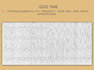 HYPERKALAEMIA K+ 9.0 - PEAKED T, WIDE QRS, SINE WAVE
APPEARANCE
QUIZ TIME
2.
 