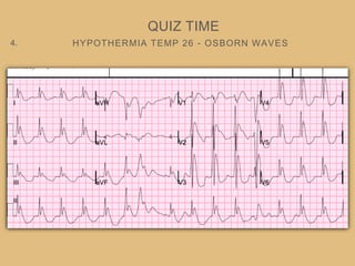HYPOTHERMIA TEMP 26 - OSBORN WAVES
QUIZ TIME
4.
 