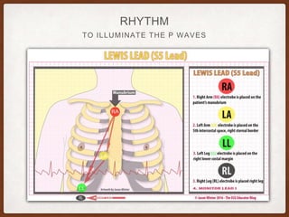 TO ILLUMINATE THE P WAVES
RHYTHM
 