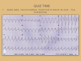 WIDE QRS, TACHYCARDIA, POSITIVE R WAVE IN AVR - TCA
OVERDOSE
QUIZ TIME
7.
 