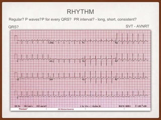 RHYTHM
Regular? P waves? PR interval? - long, short, consistent?P for every QRS?
QRS? SVT - AVNRT
 