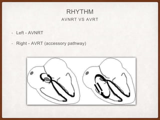 AVNRT VS AVRT
RHYTHM
• Left - AVNRT
• Right - AVRT (accessory pathway)
 