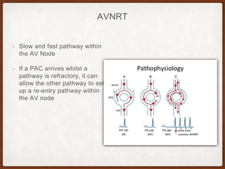 AVNRT
• Slow and fast pathway within
the AV Node
• If a PAC arrives whilst a
pathway is refractory, it can
allow the other pathway to set
up a re-entry pathway within
the AV node
 