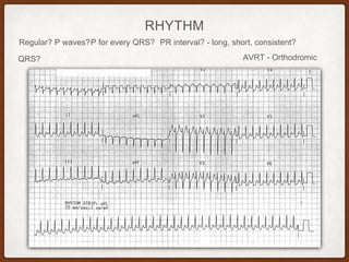 RHYTHM
Regular? P waves? PR interval? - long, short, consistent?P for every QRS?
QRS? AVRT - Orthodromic
 