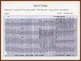 RHYTHM
Regular? P waves? PR interval? - long, short, consistent?P for every QRS?
QRS? AVRT - Antidromic
 