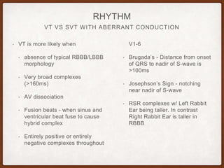 VT VS SVT WITH ABERRANT CONDUCTION
RHYTHM
• VT is more likely when
• absence of typical RBBB/LBBB
morphology
• Very broad complexes
(>160ms)
• AV dissociation
• Fusion beats - when sinus and
ventricular beat fuse to cause
hybrid complex
• Entirely positive or entirely
negative complexes throughout
V1-6
• Brugada’s - Distance from onset
of QRS to nadir of S-wave is
>100ms
• Josephson’s Sign - notching
near nadir of S-wave
• RSR complexes w/ Left Rabbit
Ear being taller. In contrast
Right Rabbit Ear is taller in
RBBB
 