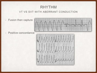 VT VS SVT WITH ABERRANT CONDUCTION
RHYTHM
• Fusion then capture
• Positive concordance
 