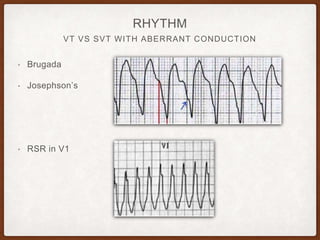 VT VS SVT WITH ABERRANT CONDUCTION
RHYTHM
• Brugada
• Josephson’s
• RSR in V1
 