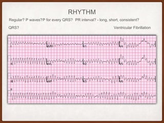 RHYTHM
Regular? P waves? PR interval? - long, short, consistent?P for every QRS?
QRS? Ventricular Fibrillation
 