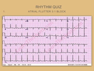 ATRIAL FLUTTER 3:1 BLOCK
RHYTHM QUIZ
1.
 