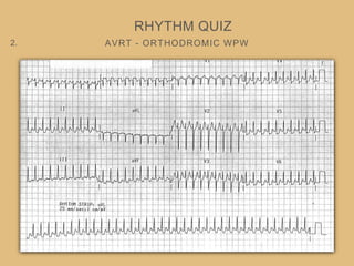 AVRT - ORTHODROMIC WPW
RHYTHM QUIZ
2.
 