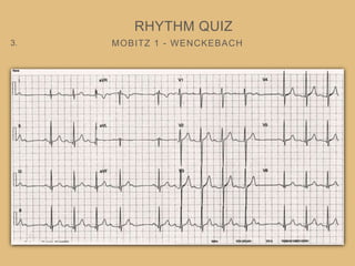 MOBITZ 1 - WENCKEBACH
RHYTHM QUIZ
3.
 