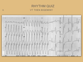 VT THEN BIGEMINY
RHYTHM QUIZ
4.
 