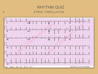 ATRIAL FIBRILLATION
RHYTHM QUIZ
6.
 