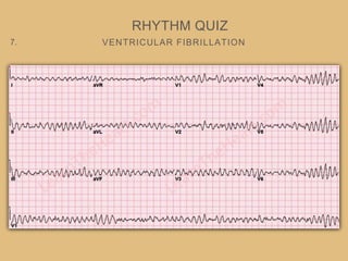 VENTRICULAR FIBRILLATION
RHYTHM QUIZ
7.
 