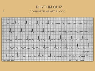 COMPLETE HEART BLOCK
RHYTHM QUIZ
9.
 
